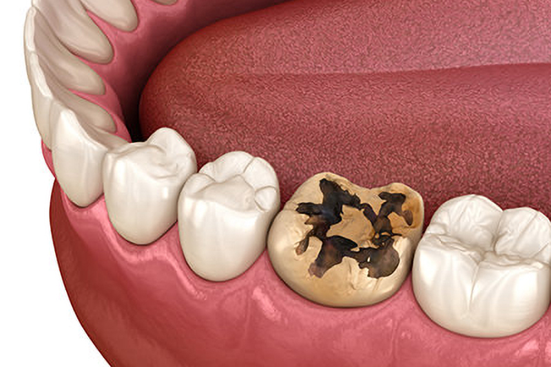 むし歯を引き起こすおもな原因