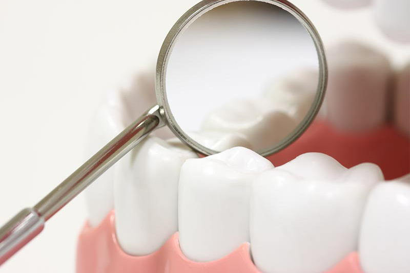 初期のむし歯は自覚症状が少ない