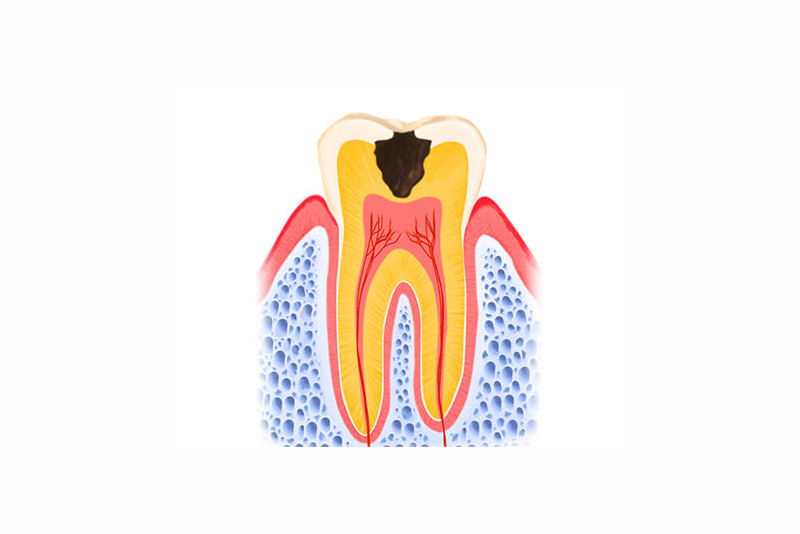 象牙質に達したむし歯（C2）