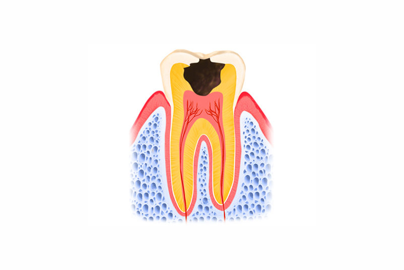 神経まで進行したむし歯（C3）