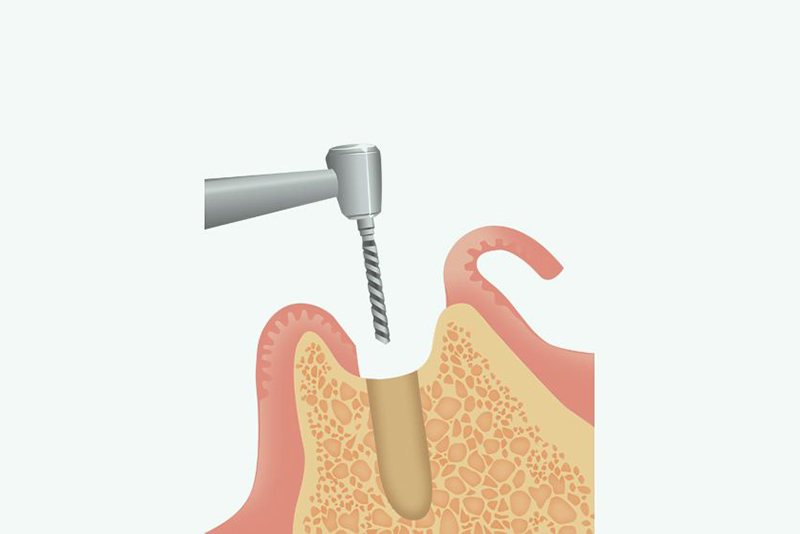 インプラント体の埋入手術