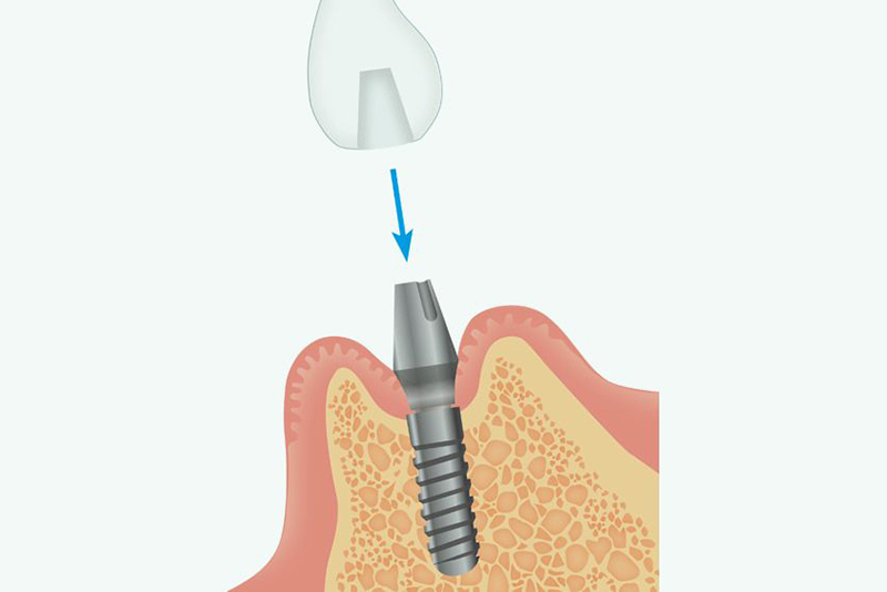 上部構造（被せ物）の製作・仮歯の装着