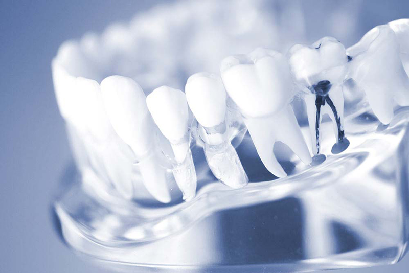 できるだけ歯を守るための根管治療