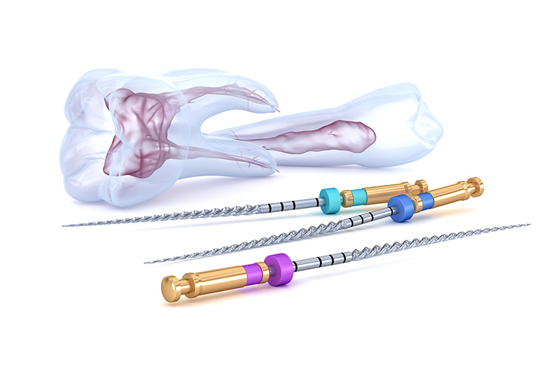 感染した歯髄の除