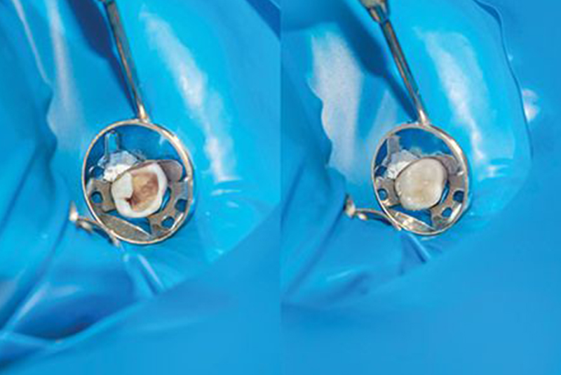 土台・仮歯の装着