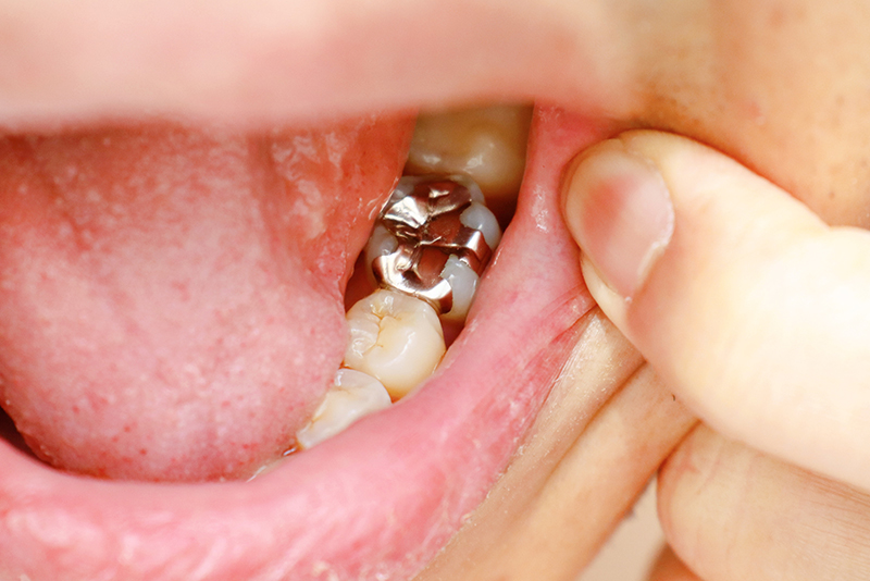 大人のむし歯に多い特徴と注意点