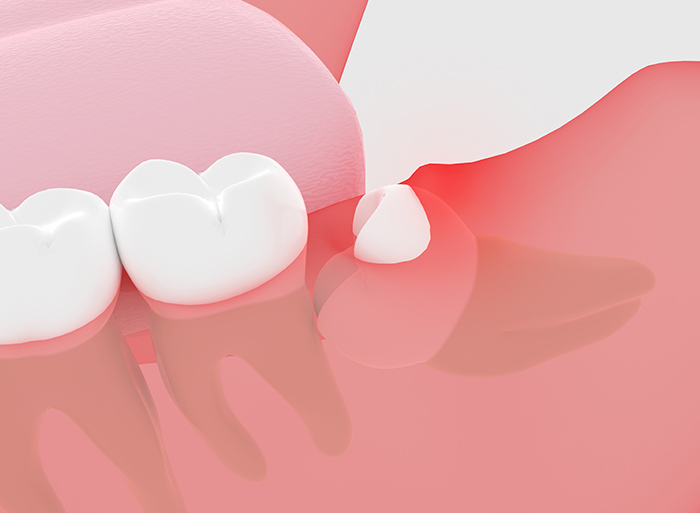 親知らずの難症例にも対応