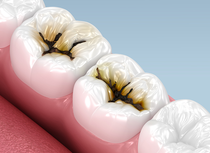 むし歯