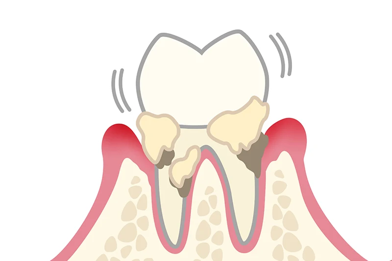 中程度の歯周炎