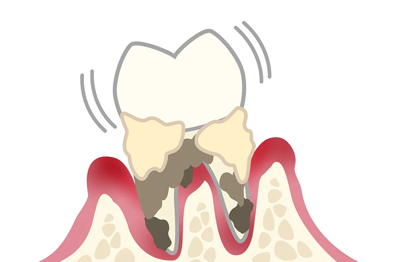 重度の歯周炎