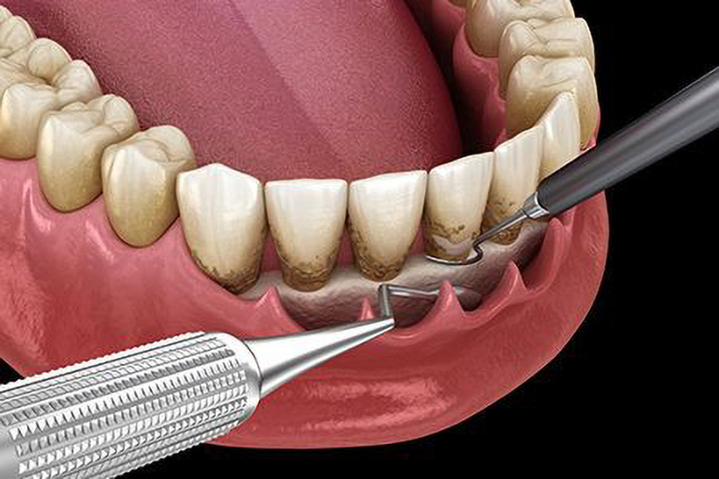 中程度以上の歯周病に対する専門的な治療